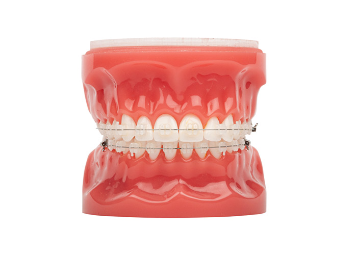 Ceramic Brackets Clear Braces Inwood Village